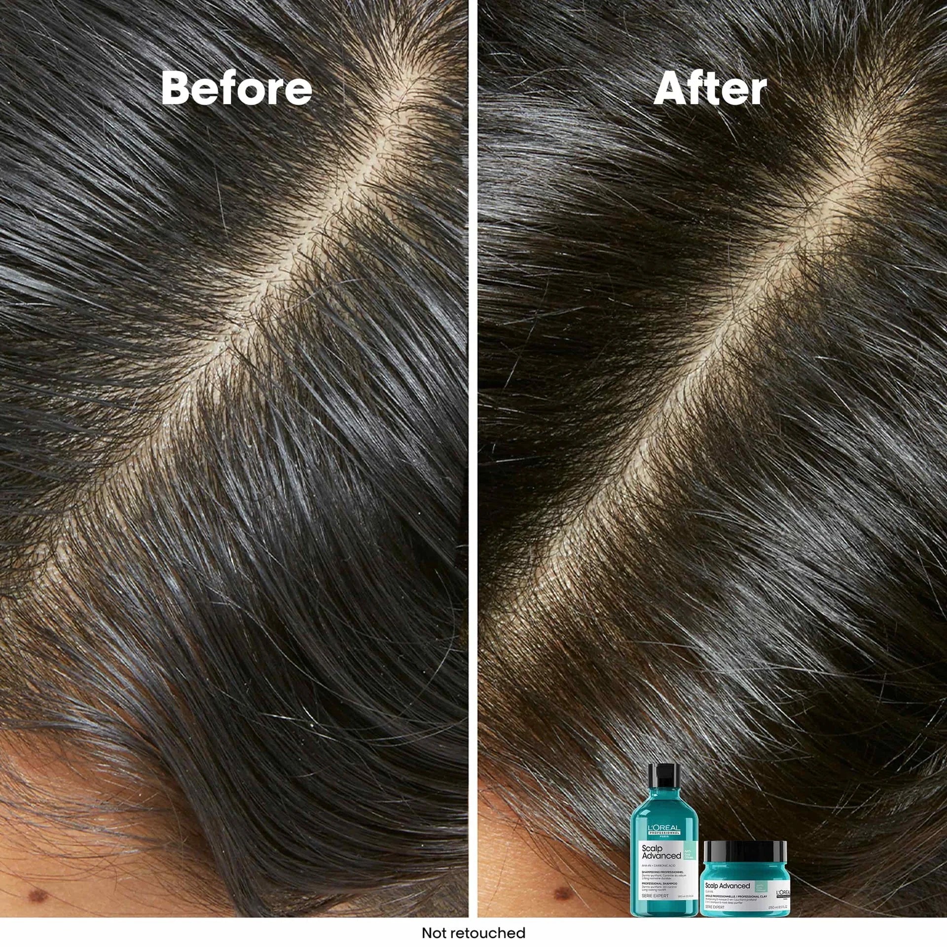 Tecnología Scalp Dermo-Clarifier L'Oréal Professionnel para cuero cabelludo graso